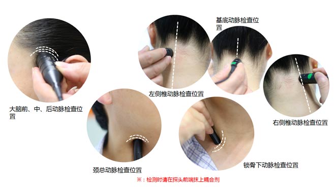 多普勒血管搜索TCD儀供應(yīng).jpg 多普勒血管搜索TCD儀供應(yīng).jpg