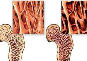 骨質(zhì)疏松